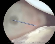 Shoulder arthoscopy | Spinal needle at lower boundary of rotator interval