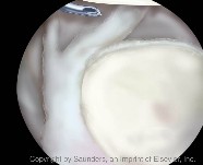Shoulder arthoscopy | Suture shuttle tip