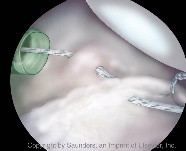 Shoulder arthoscopy | Suture shuttled under labrum and through capsule