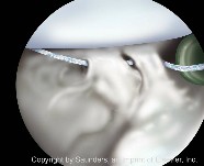 Shoulder arthoscopy | Suture shuttled via posterior portal