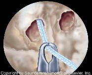 Knee arthoscopy | Suture grasper through tibial PL tunnel
