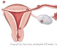 Gynecology | Abnormal implantation sites