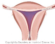 Gynecology | Tubular microimplants