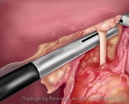 Laparoscopic | Abdominal surgery