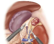 Laparoscopic | Adrenal gland approach