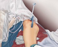 Femoral fracture surgery